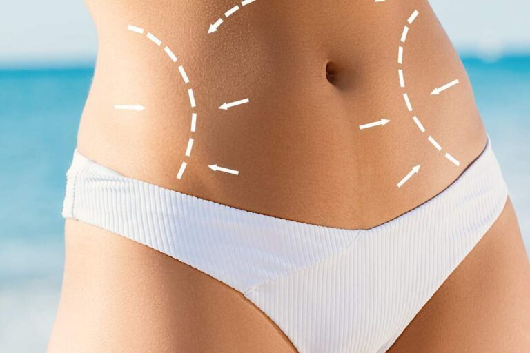 A woman wearing white bikini bottoms had her waist sides marked with a pencil before tummy tuck surgery