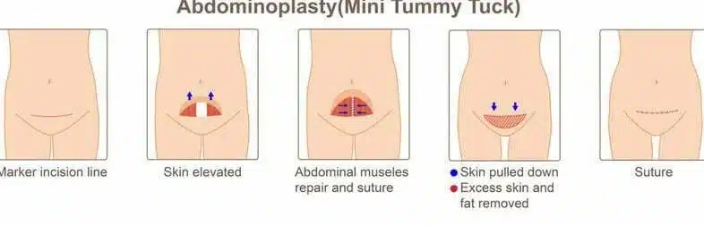 step-by-step illustration of tummy tuck surgery