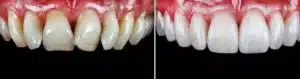 dental veneers turkey