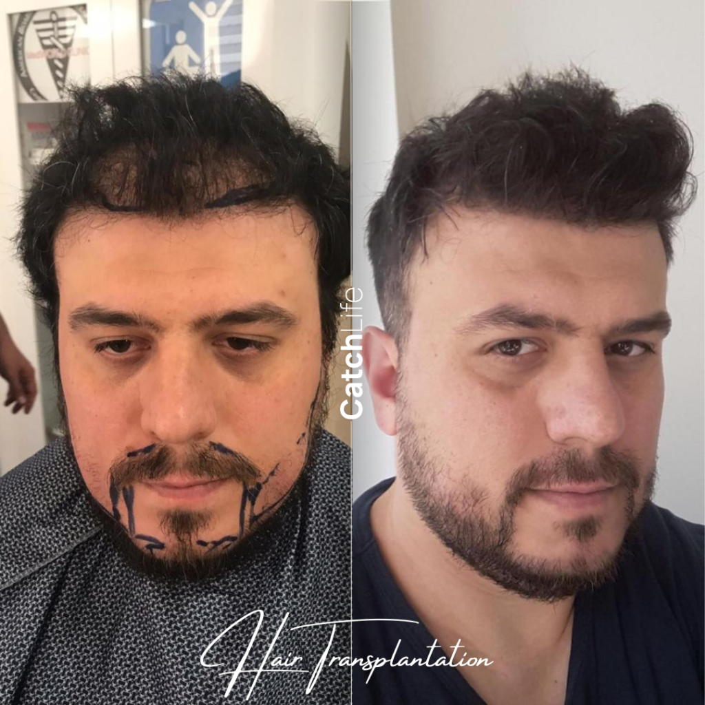 hair before after