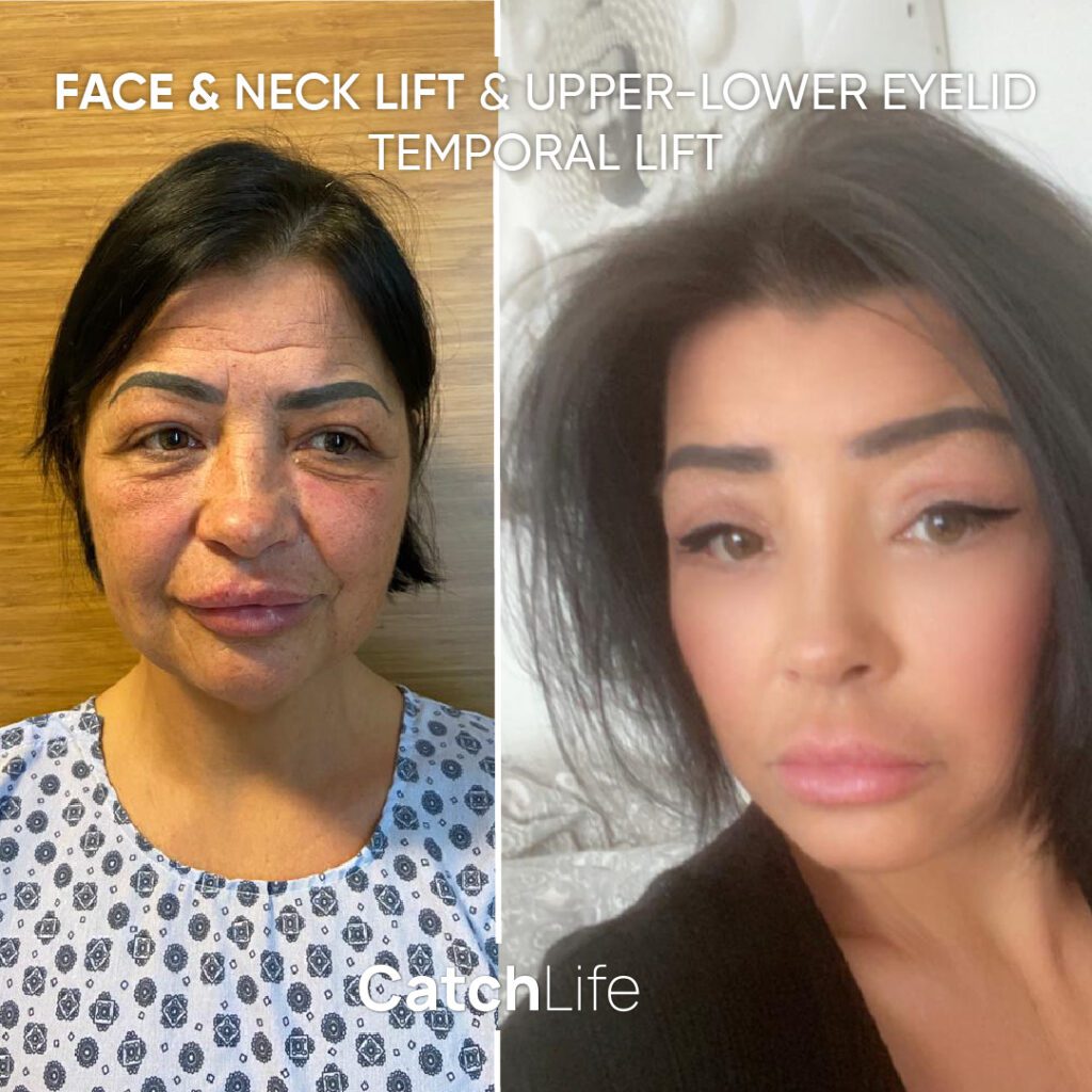 Face Neck Lift, upper-lower eyelid, temporal lift