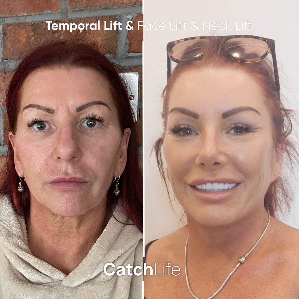 Temporal&Face&Neck Lift