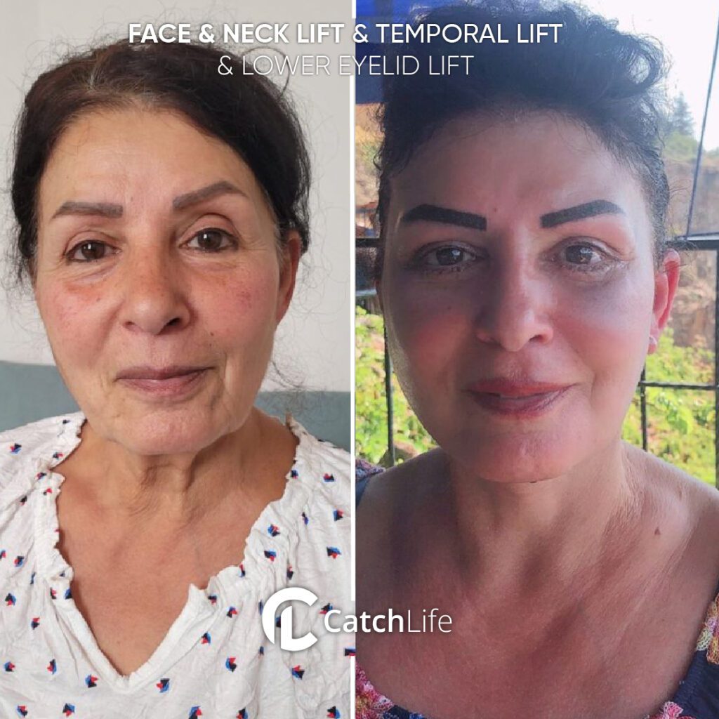 face neck- tempo-lower -100