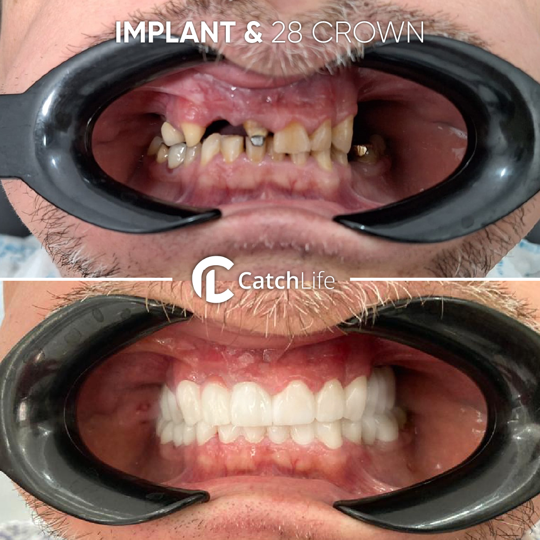 IMPLANT VE 28 CROWN-100 (1)